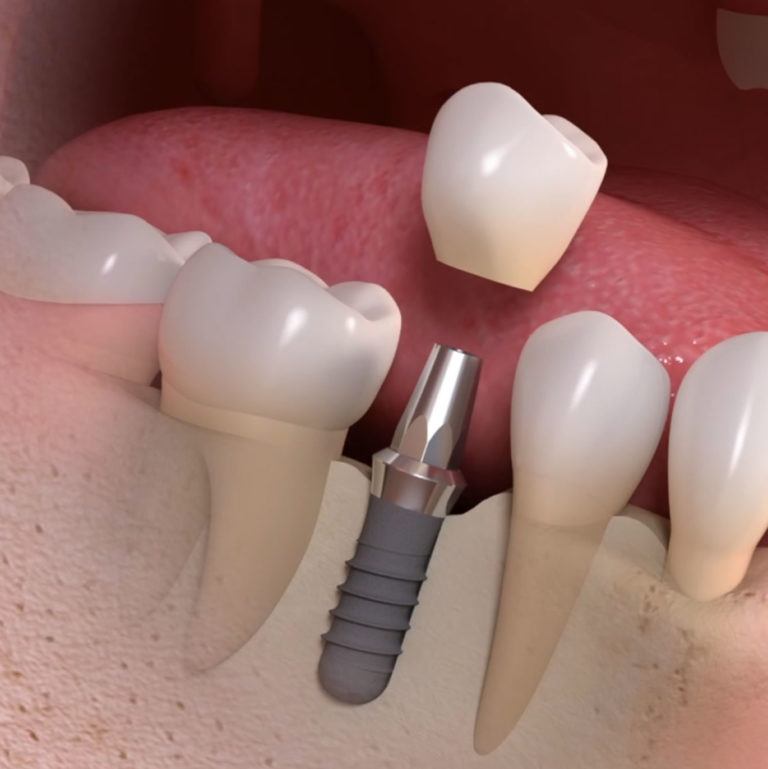 How to find qualified dentists for Dental Implant Costs